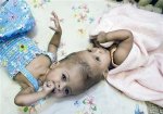 В Лондоне врачи разделили сиамских близнецов, сросшихся головами